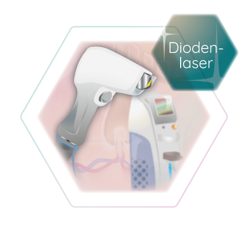 Illustration Diodenlaser